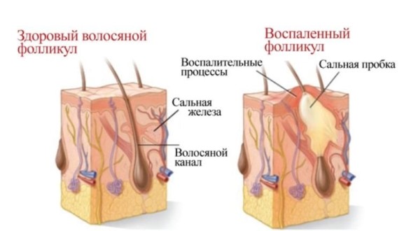 Закупоривание волосяных фолликул