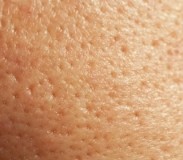 что делать если широкие поры