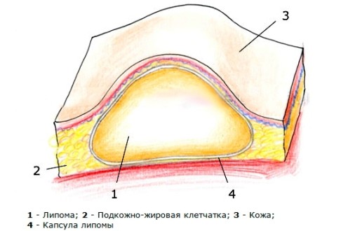 Липома